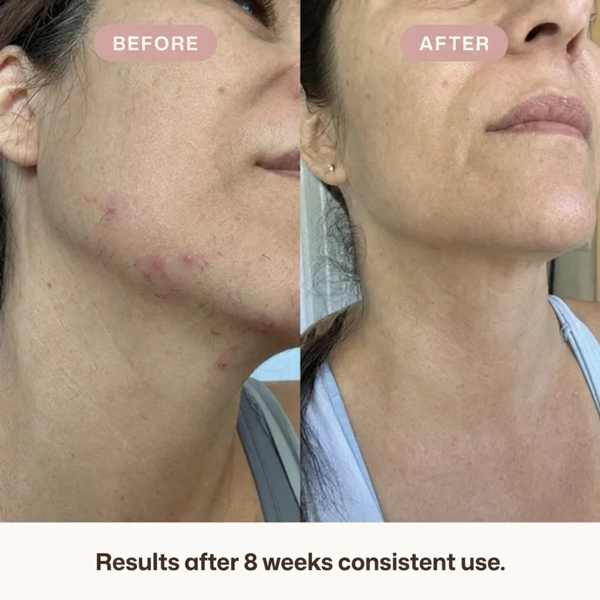 Cyperus rotundus oil for unwanted hair - slower, finer regrowth